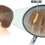 Head lice: How to get rid of them and stop them coming back