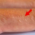 If You See These Painful Red Bumps, You May Have Dyshidrotic Eczema