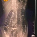 Here’s What You Need To Know About Chronic Constipation: A Silent Killer To Your Digestive Health
