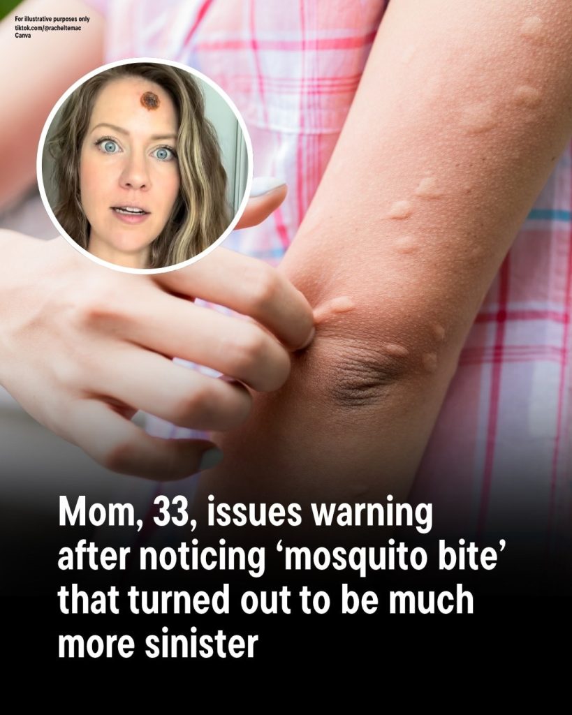 Mom, 33, issues warning after noticing ‘mosquito bite’ that turned out to be much more sinister
