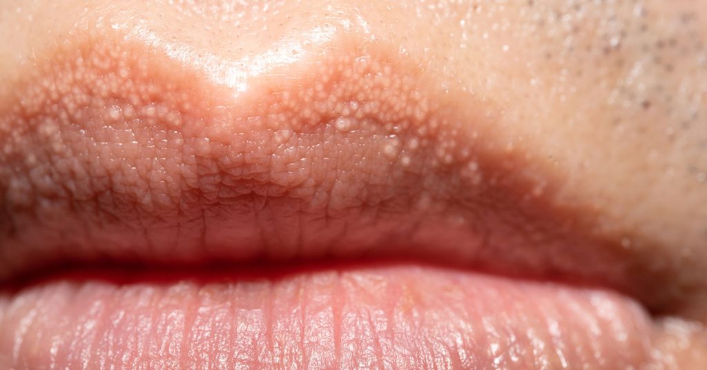 What Are the White Bumps on Your Private Parts — and Should You Be Worried?