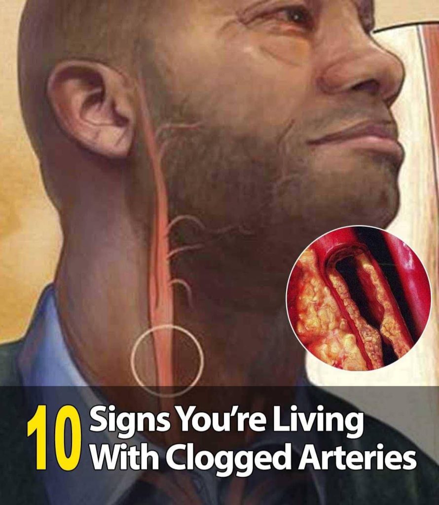 10 Signs You’re Living With Clogged Arteries